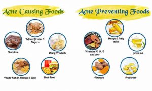 Acne and nutrition