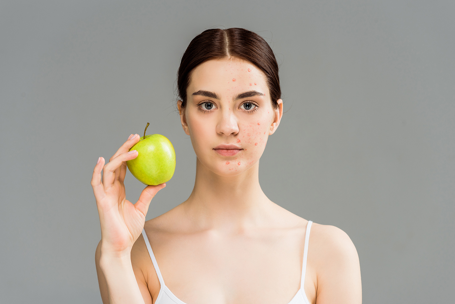 Acne and nutrition