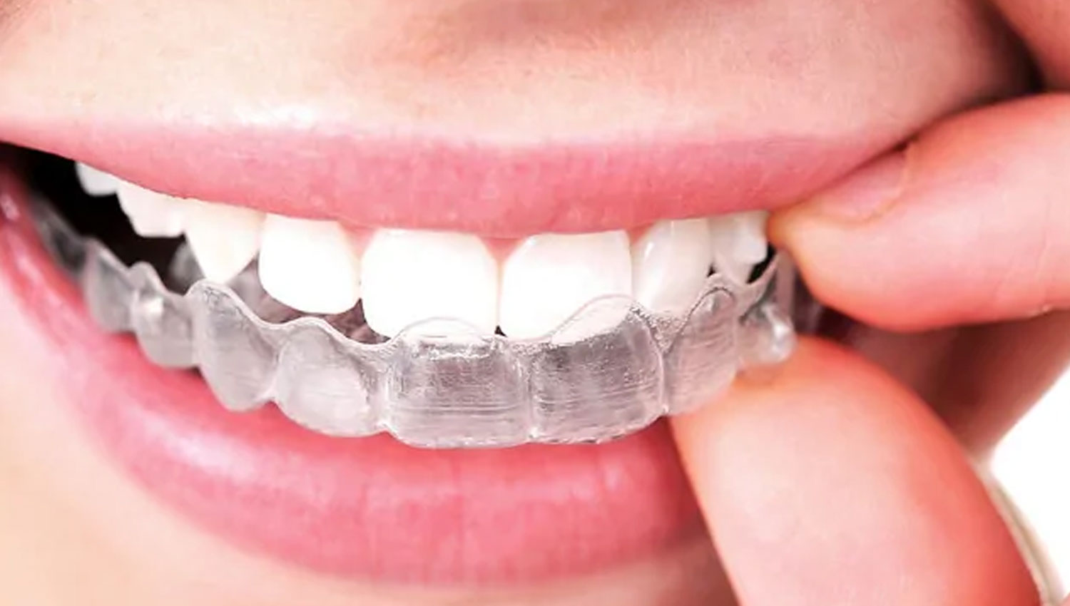 Invisalign