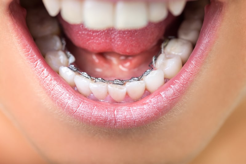 Invisalign